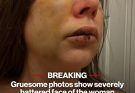 Gruesome photos show severely battered face of the woman knocked out during horrifying Cincinnati brawl