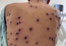 😱😱Your Guide to Effective Blackhead Removal
