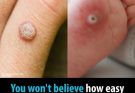 Say Goodbye to Skin Tags and Warts: Easy Removal with Hydrogen Peroxide…. see more👇