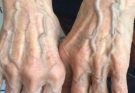 When to Worry About Veins That Appear Out of Nowhere